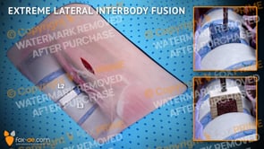 Extreme Lateral Interbody Fusion L2-L3 Left (Animation)