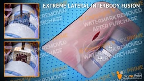 Extreme Lateral Interbody Fusion L2-L3 Right (Animation)