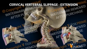 Cervical Vertebral Slippage - Extension (Animation)