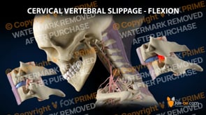 Cervical Vertebral Slippage - Flexion (Animation)