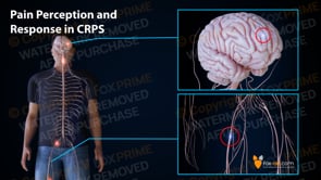Pain Perception and Response in CRPS (Animation) – FoxPrime