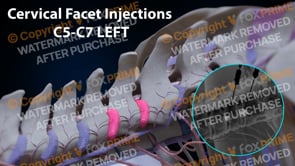 Cervical Facet Injections C5-C7 Left (No Text)  | Female | Dark