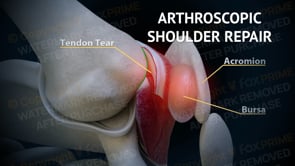 Arthroscopic Shoulder Repair (No Text)   | Light