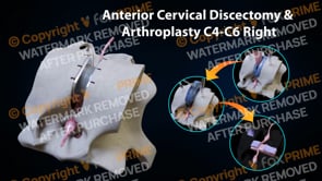 Anterior Cervical Discectomy and Arthroplasty C4-C6 Right  | Female | Light