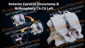 Anterior Cervical Disc Replacement C4-C6 Left  | Female | Light