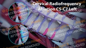 Cervical Radiofrequency Ablation C5-C7 Left  | Female | Dark
