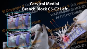 Cervical Medial Branch Block C5-C7 Left  | Female | Light