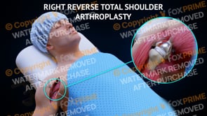 Reverse Total Shoulder Arthroplasty - Right (Animation)