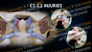 C1-C2 Ligament Injuries Left (Animation)