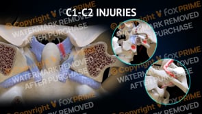 C1-C2 Ligament Injuries Right (Animation)