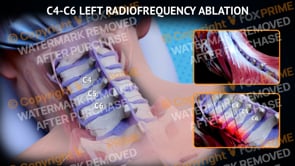C4-C6 Left Radiofrequency Ablation  | Female | Light