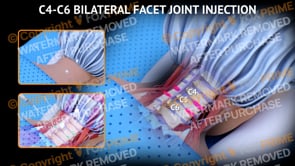C4-C6 Bilateral Facet Joint Injection  | Female | Light