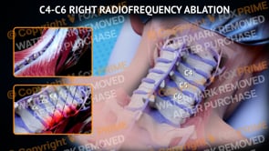 C4-C6 Right Radiofrequency Ablation  | Female | Light