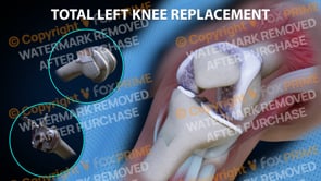 Total Left Knee Replacement   | Light