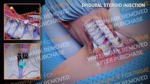 C7-T1 Epidural Steroid Injection  | Female | Light