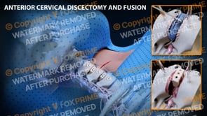 C4-C6 Anterior Cervical Discectomy and Fusion   | Light