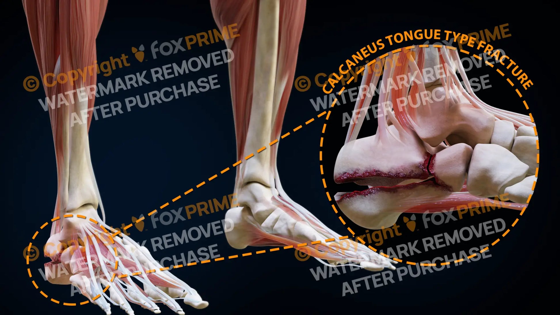 Right Calcaneus Tongue Type Fracture Still Shot