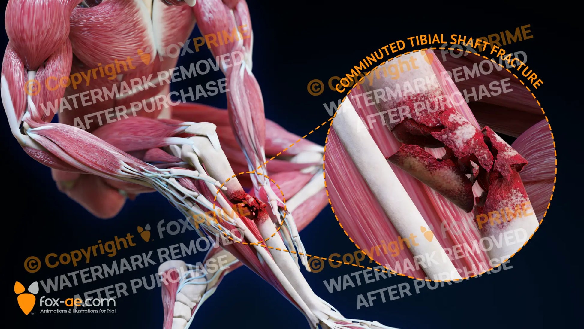 Right Comminuted Tibial Shaft Fracture Still Shot