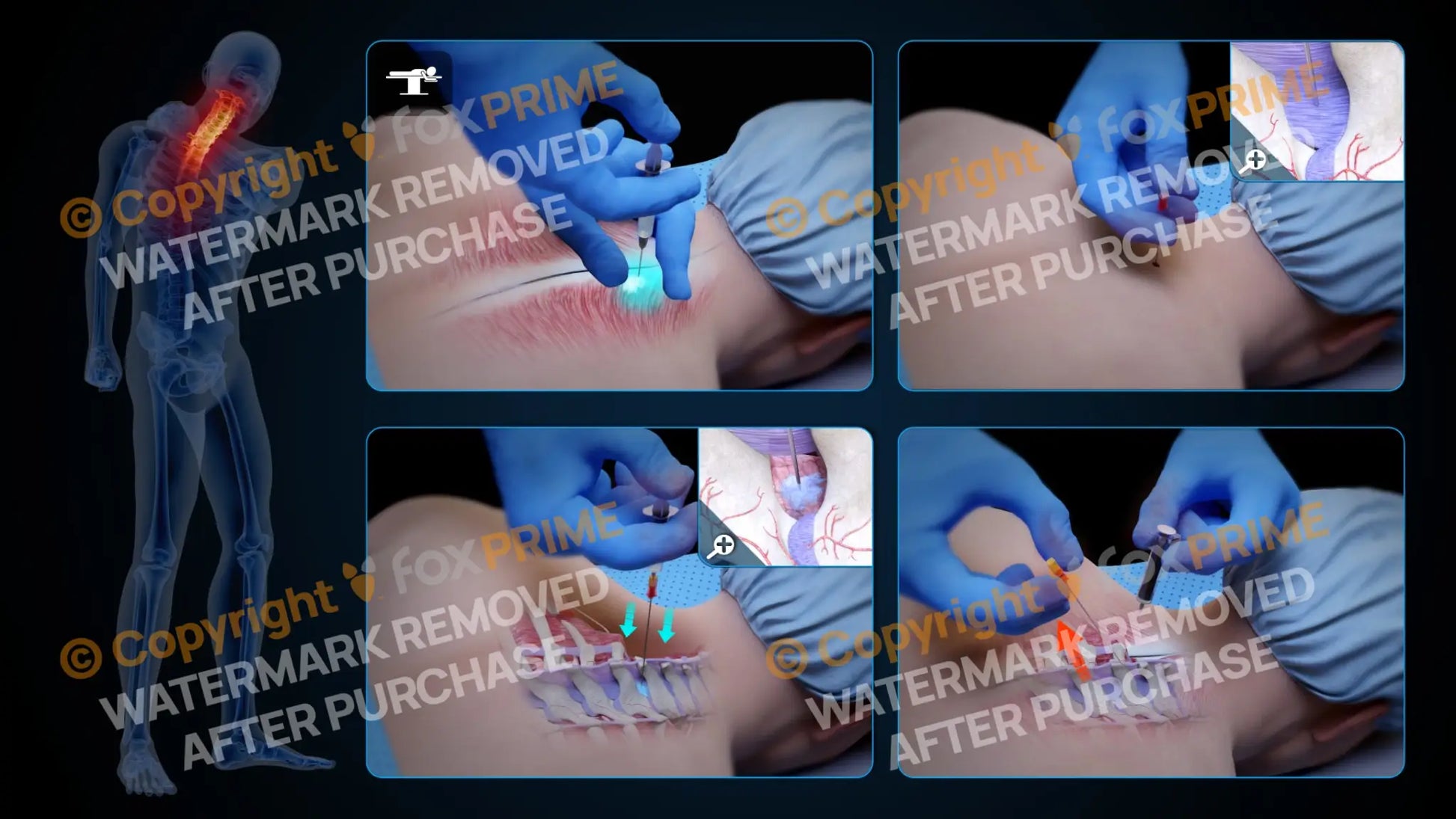 Right Epidural Injection C7-T1 (No Text) Still Shot
