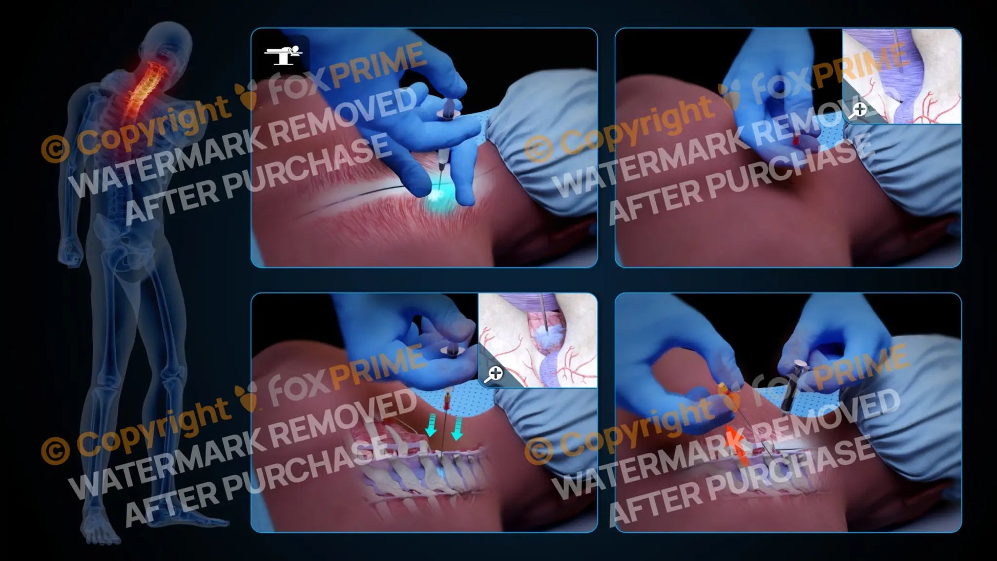 Right Epidural Injection C7-T1 (No Text) Still Shot