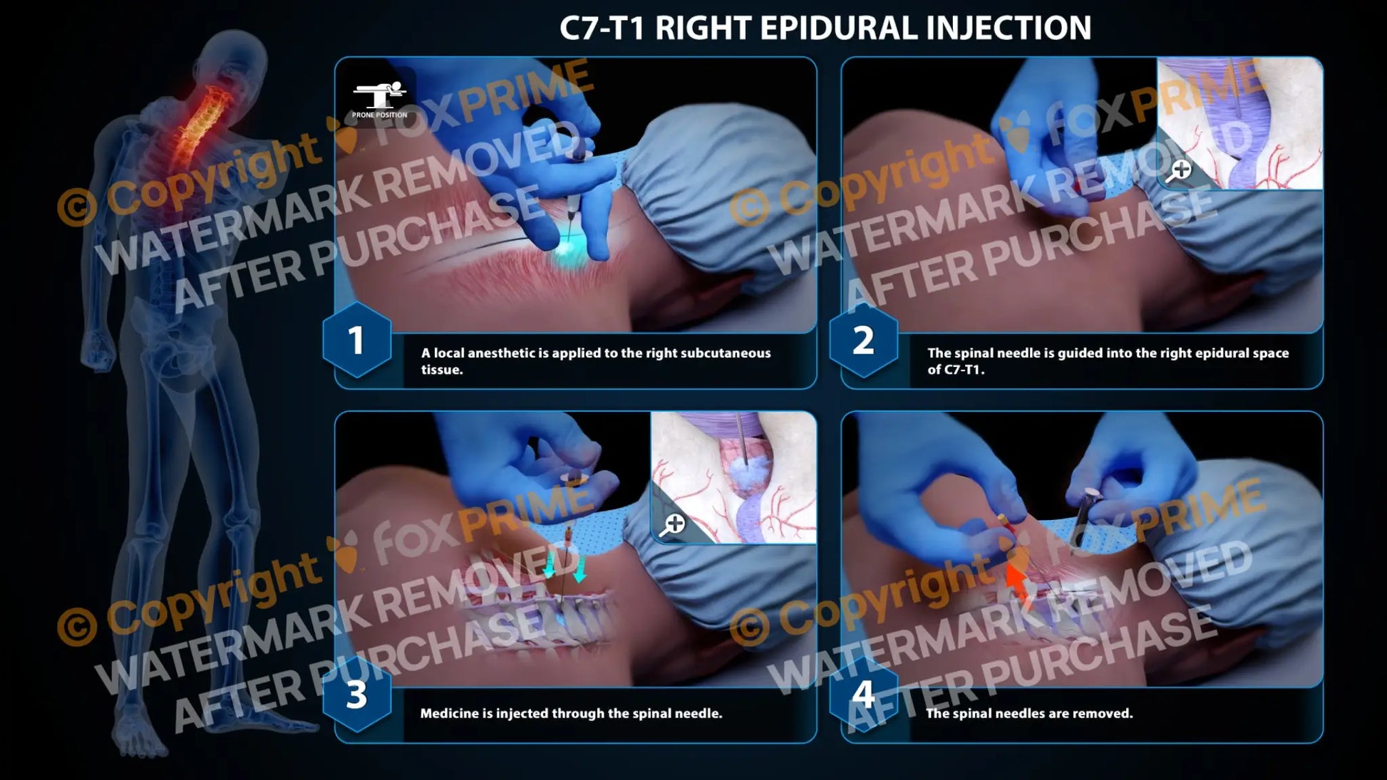 Right Epidural Injection C7-T1 (PowerPoint) PowerPoint
