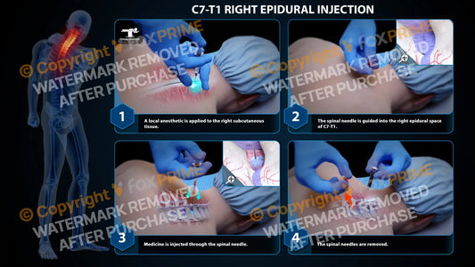 Right Epidural Injection C7-T1 (PowerPoint) PowerPoint