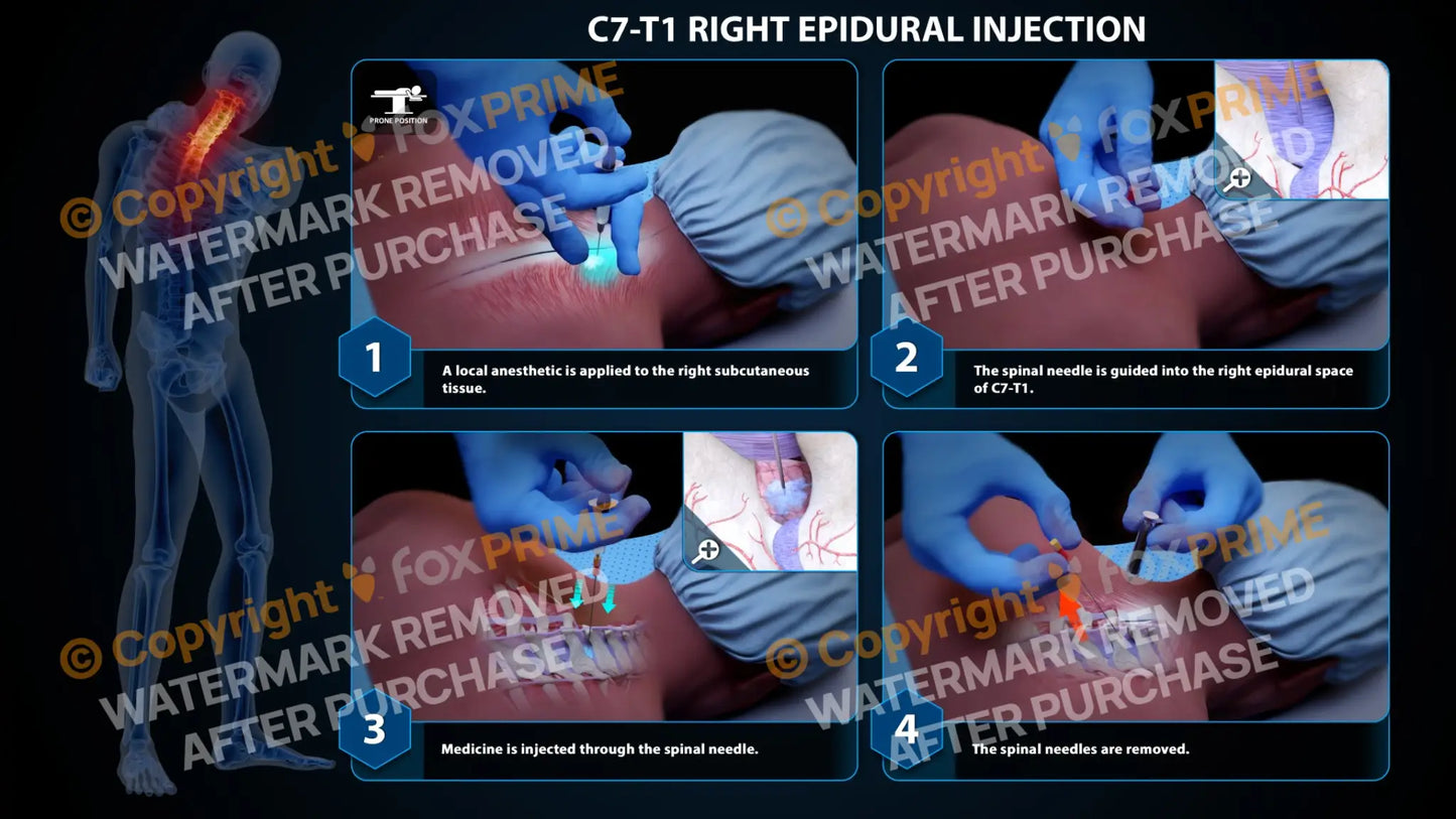 Right Epidural Injection C7-T1 (PowerPoint) PowerPoint