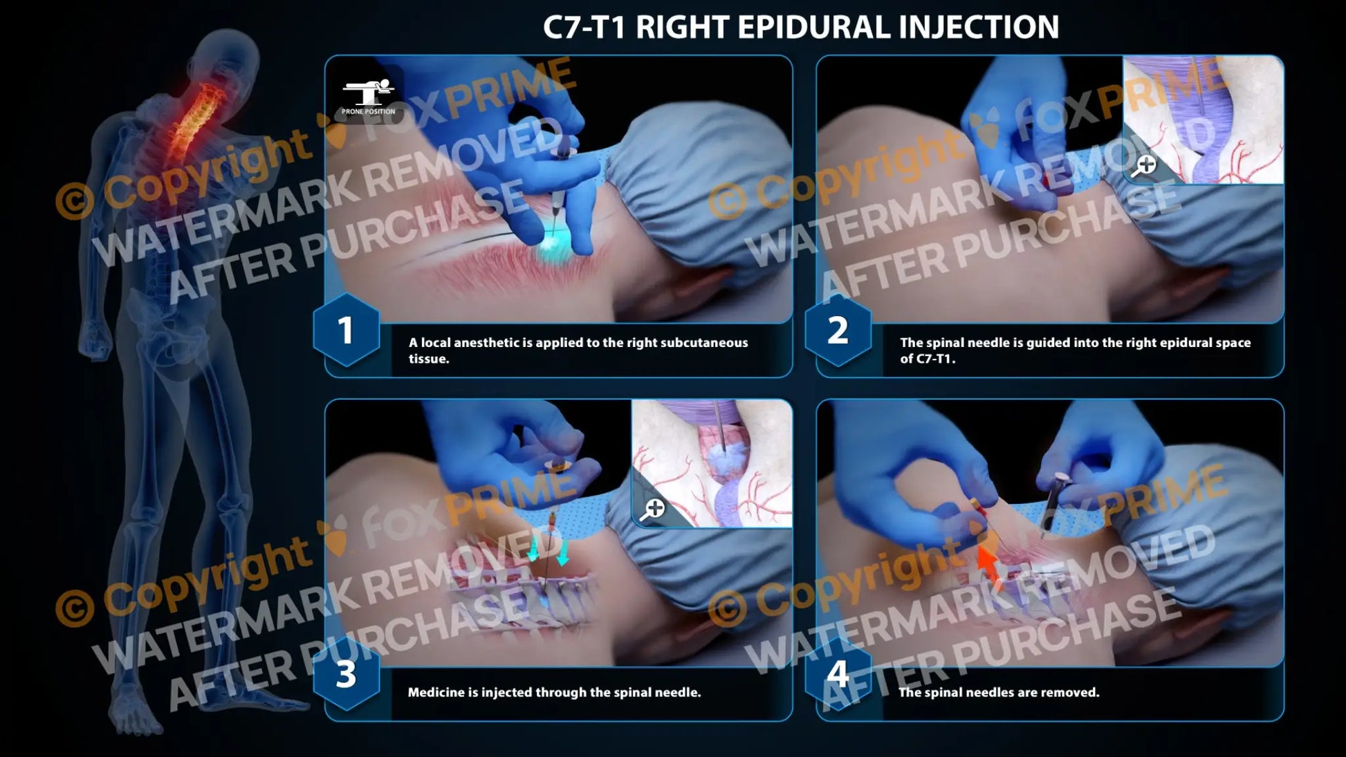 Right Epidural Injection C7-T1 Still Shot