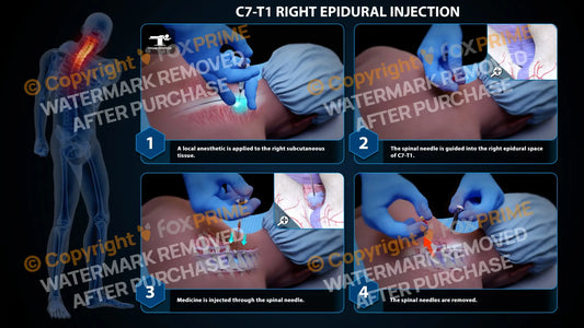 Right Epidural Injection C7-T1 Still Shot