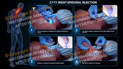 Right Epidural Injection C7-T1 Still Shot