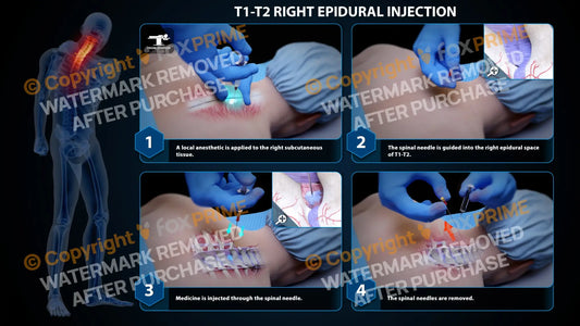 Right Epidural Injection T1-T2 (PowerPoint) - PowerPoint
