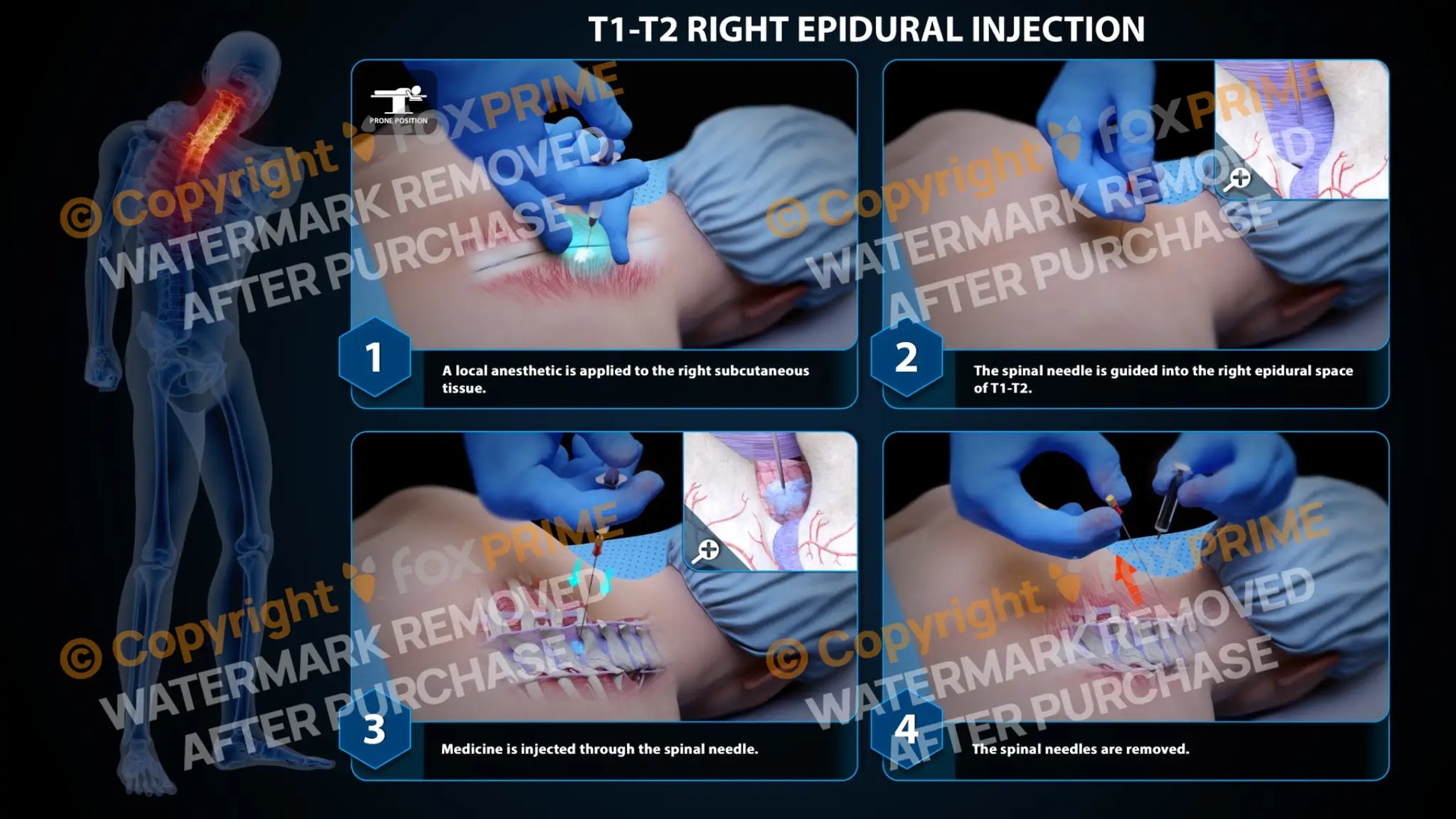 Right Epidural Injection T1-T2 - Still Shot