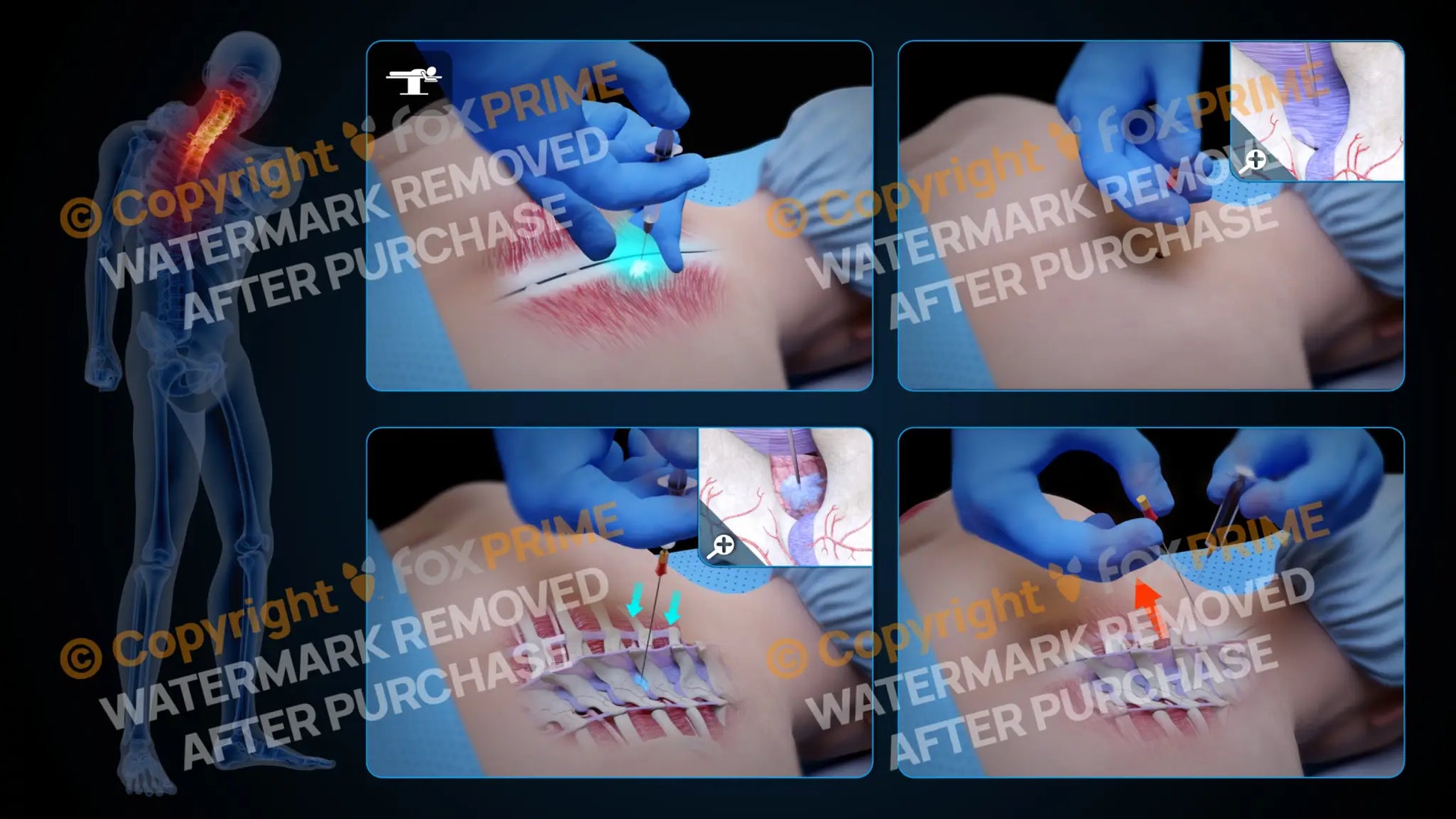 Right Epidural Injection T2-T3 (No Text) Still Shot
