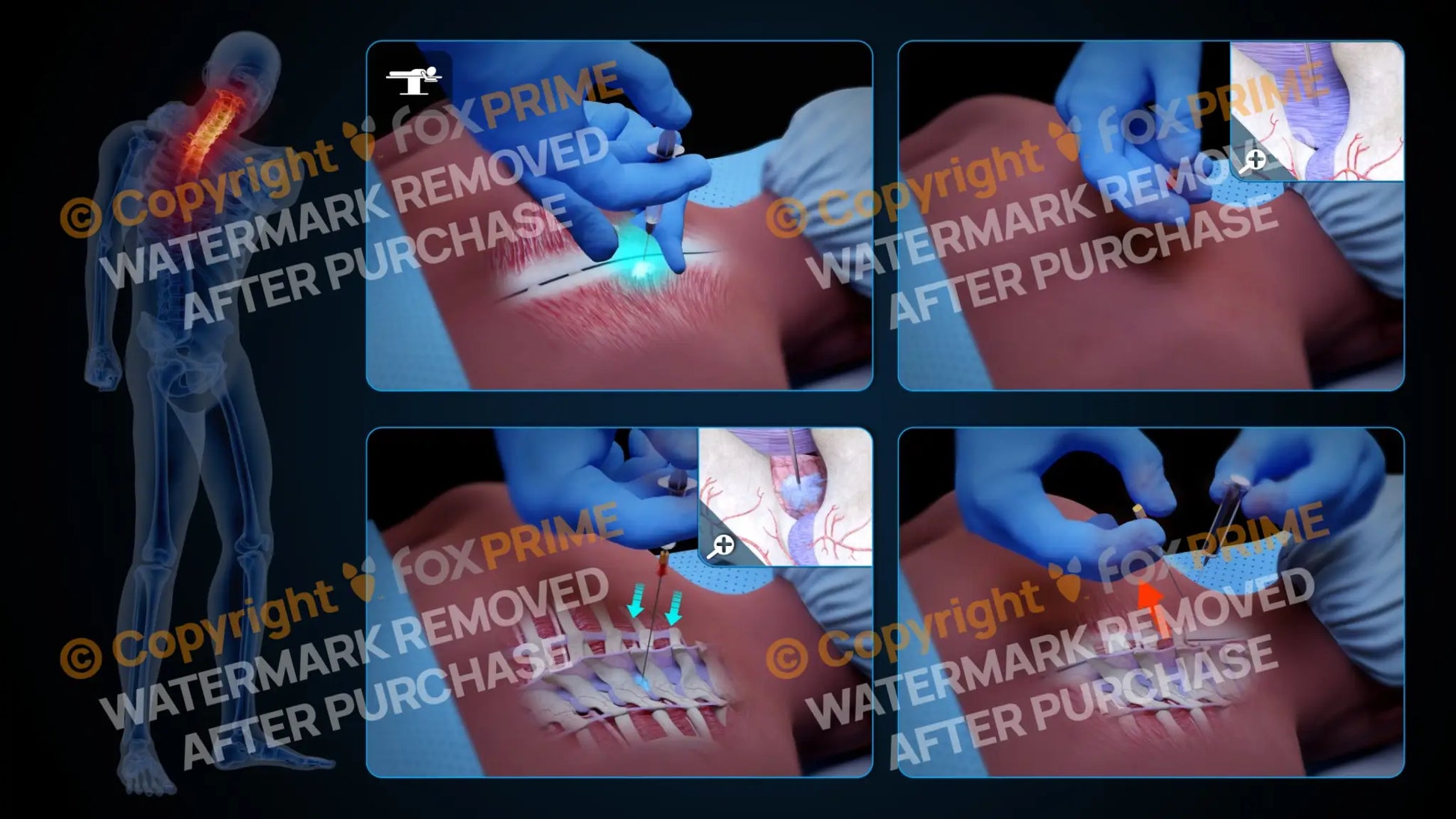 Right Epidural Injection T2-T3 (No Text) Still Shot
