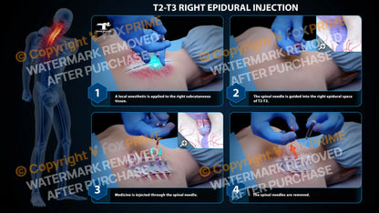 Right Epidural Injection T2-T3 (PowerPoint) PowerPoint