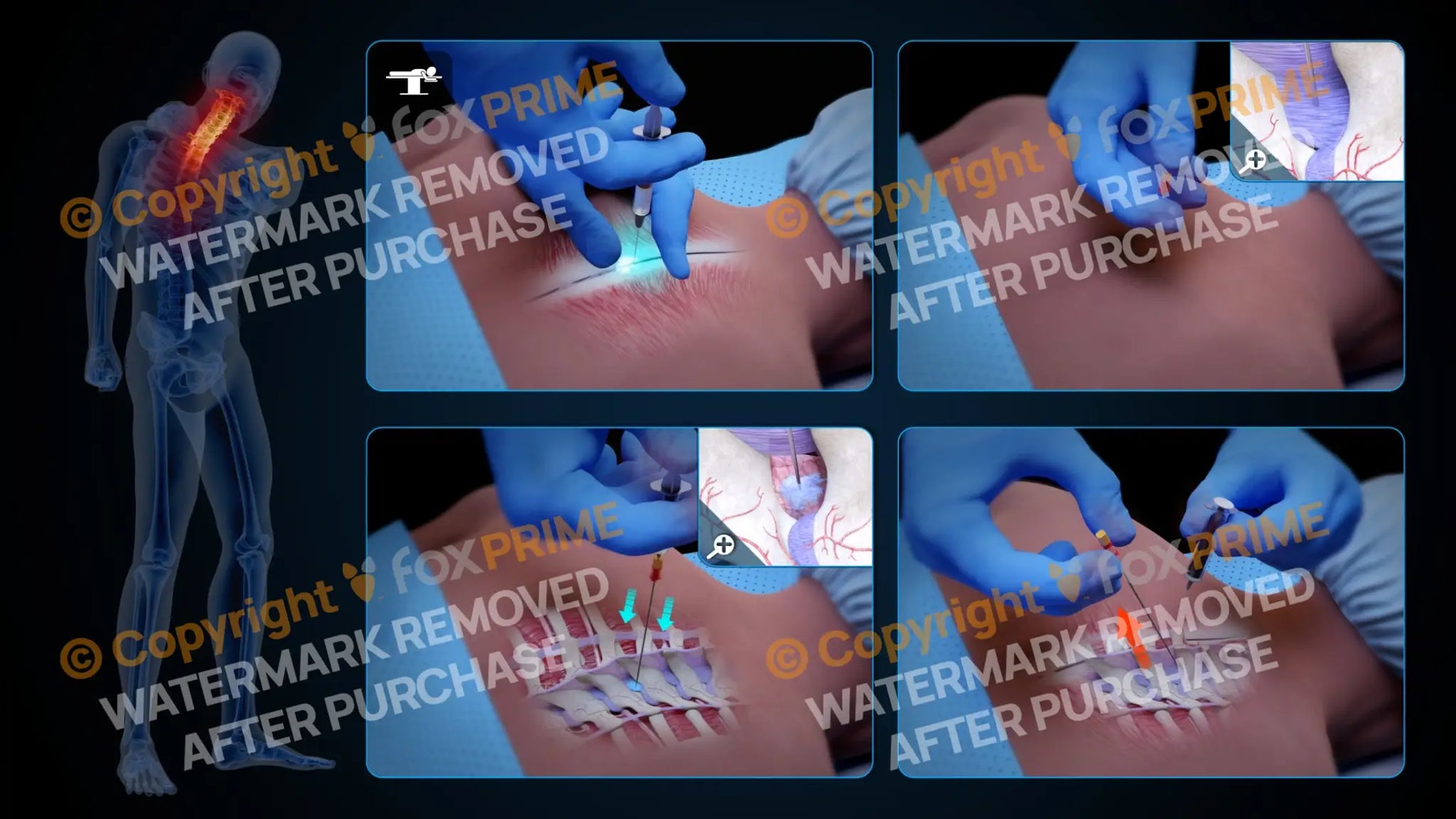 Right Epidural Injection T3-T4 (No Text) Still Shot