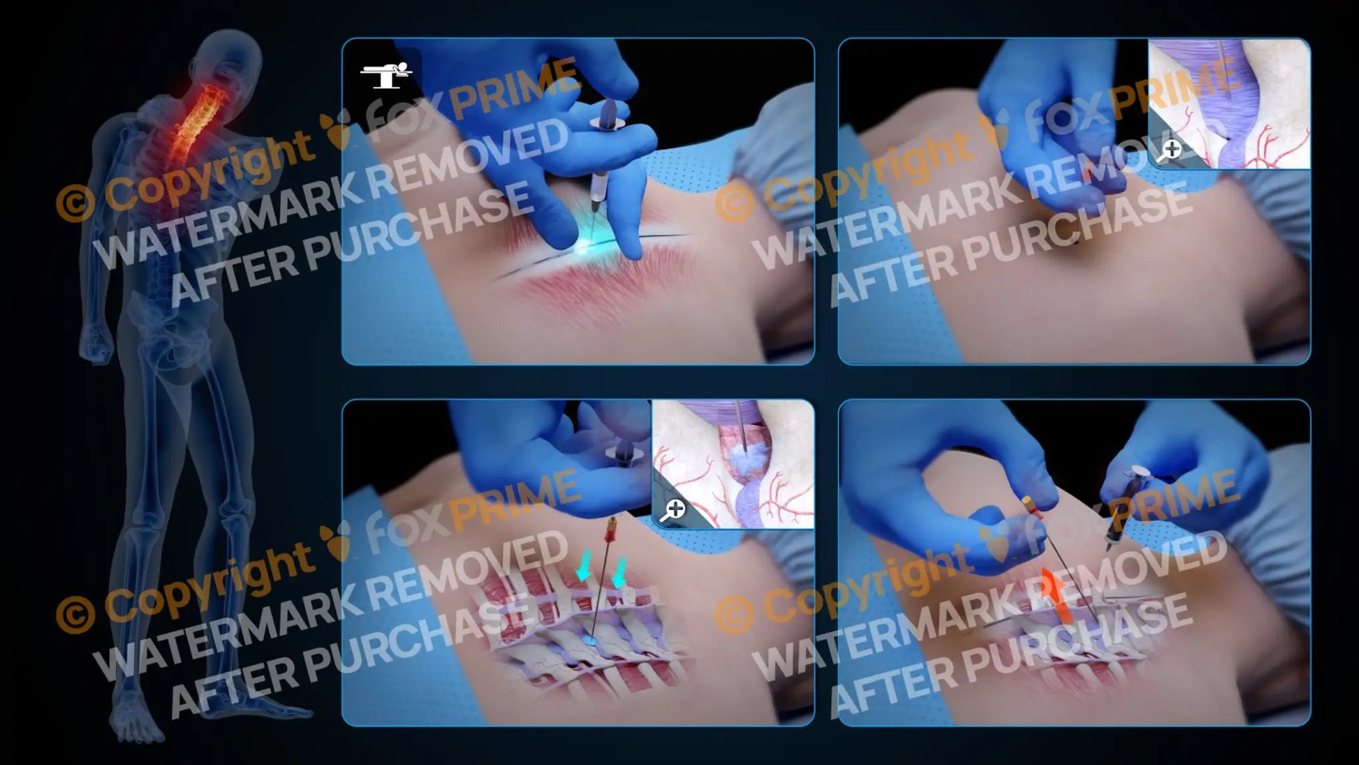 Right Epidural Injection T3-T4 (No Text) Still Shot