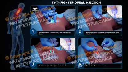 Right Epidural Injection T3-T4 Still Shot