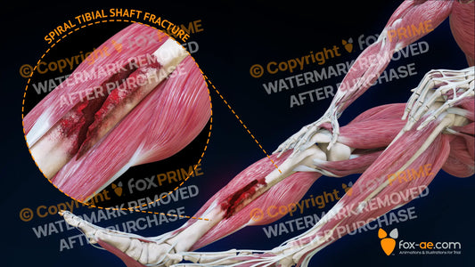 Right Spiral Tibial Shaft Fracture Still Shot