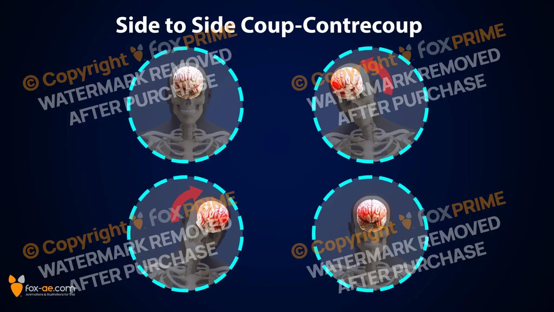 Front To Back Coup-Contrecoup Single Use / Male Still Shot