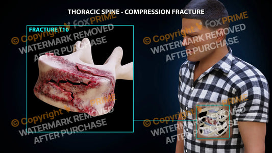 T10 Compression Fracture Single Use / Male / Light Still Shot