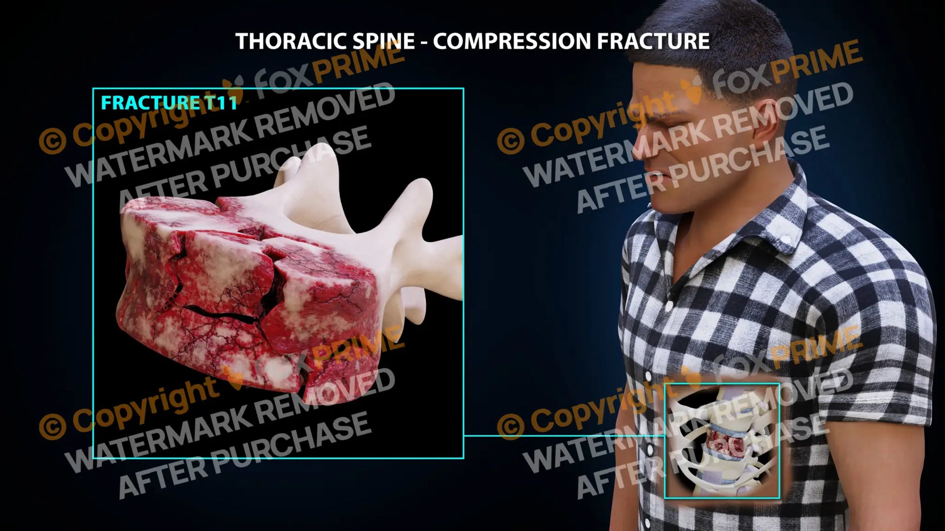 T11 Compression Fracture Single Use / Male / Light Still Shot
