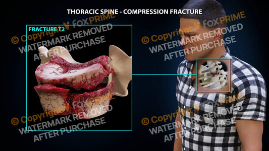 T2 Compression Fracture Single Use / Male / Light Still Shot