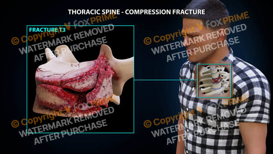 T3 Compression Fracture Single Use / Male / Light Still Shot