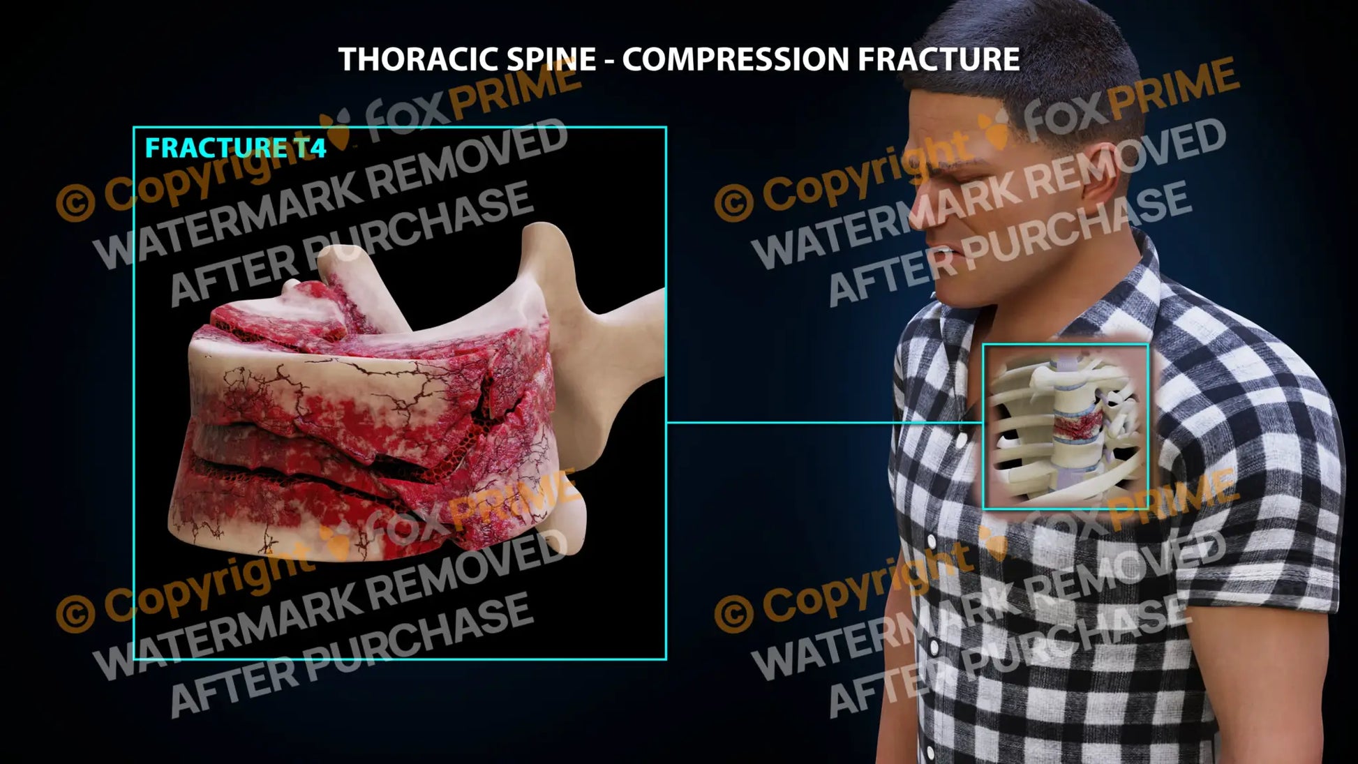 T4 Compression Fracture Single Use / Male / Light Still Shot