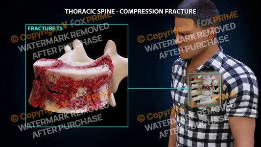 T5 Compression Fracture Single Use / Male / Light Still Shot