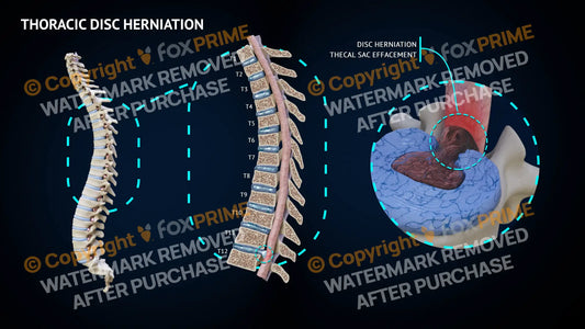 Thoracic Herniation T11-12 Still Shot