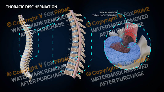 Thoracic Herniation T9-10 Still Shot