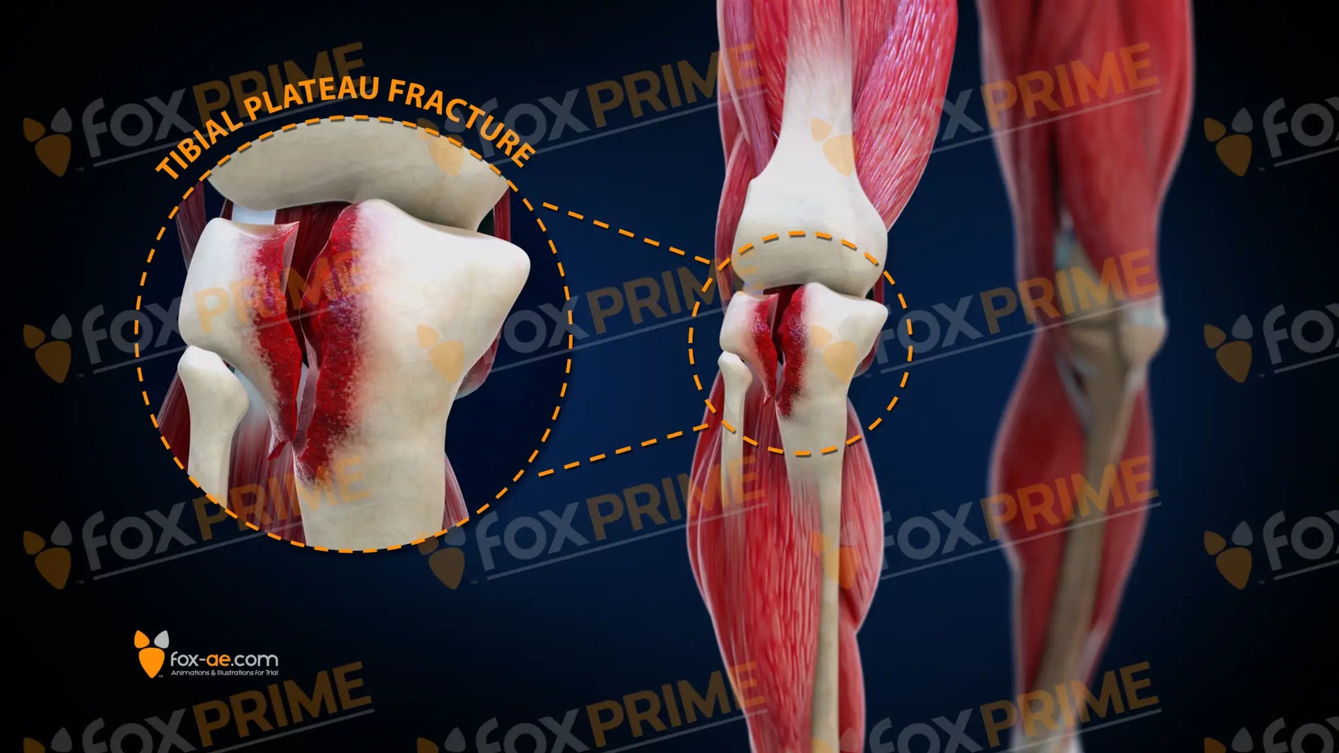 Tibial Plateau Fracture Right Still Shot