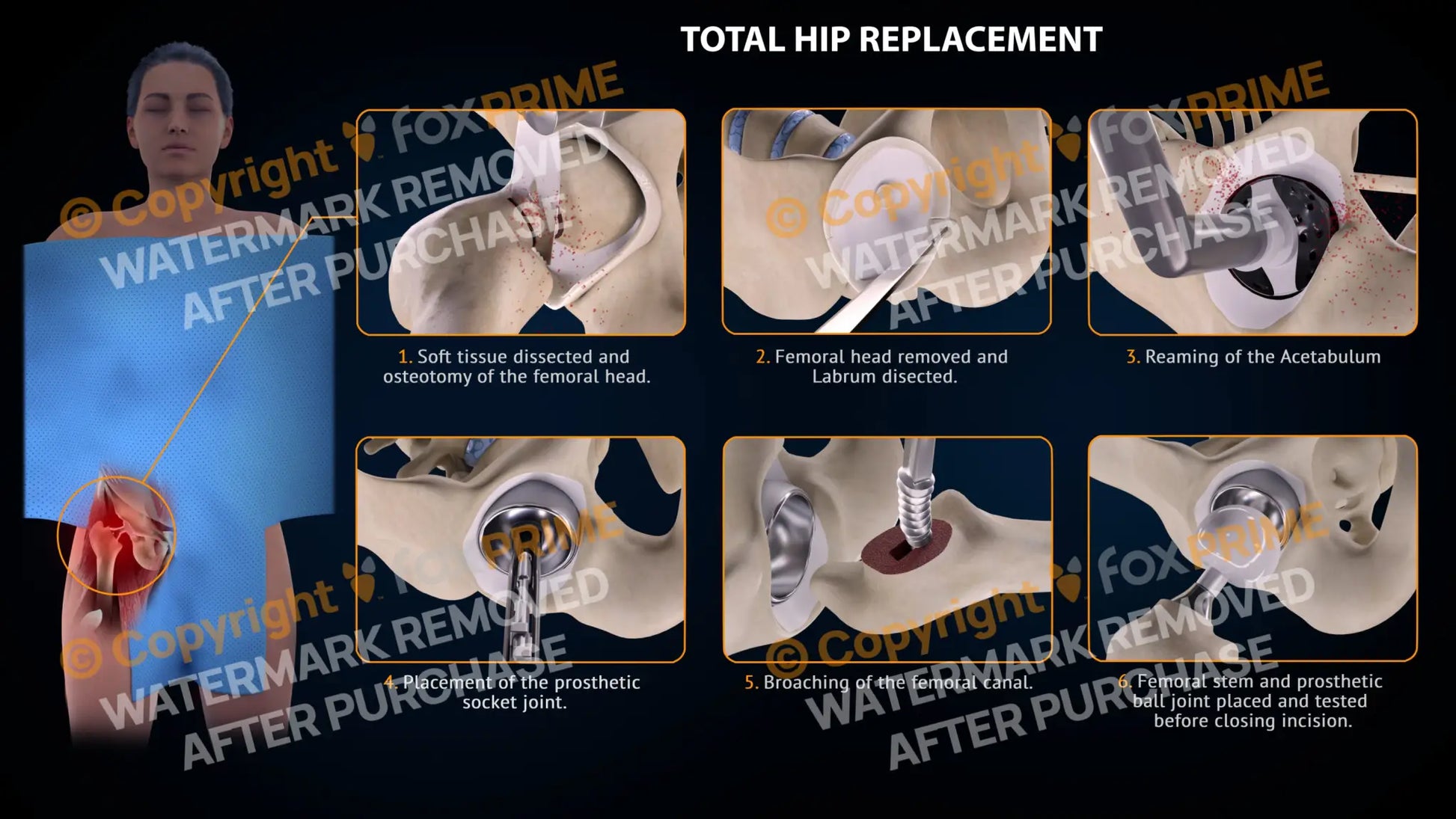 Total Hip Replacement Right Single Use / Female Light Still Shot